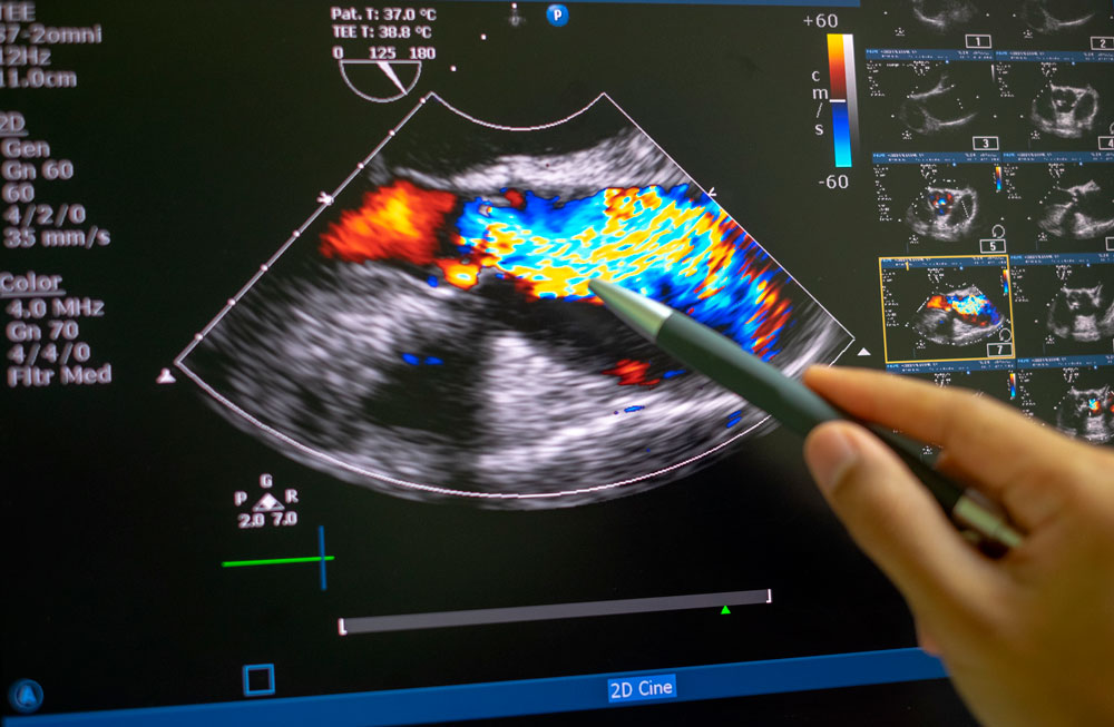 Ecografía Doppler