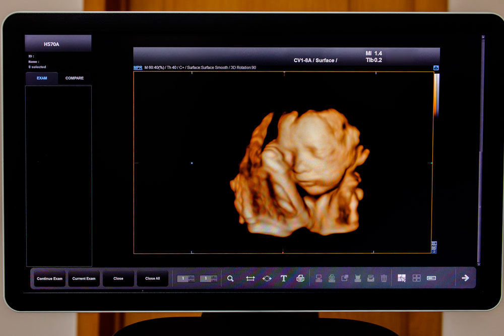 Ultrasonido 3D